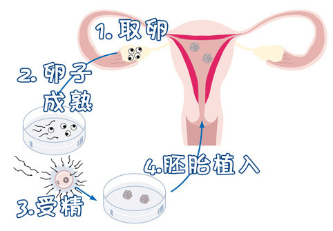 靠谱志愿者供卵咨询